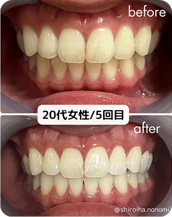 20代女性/5回目